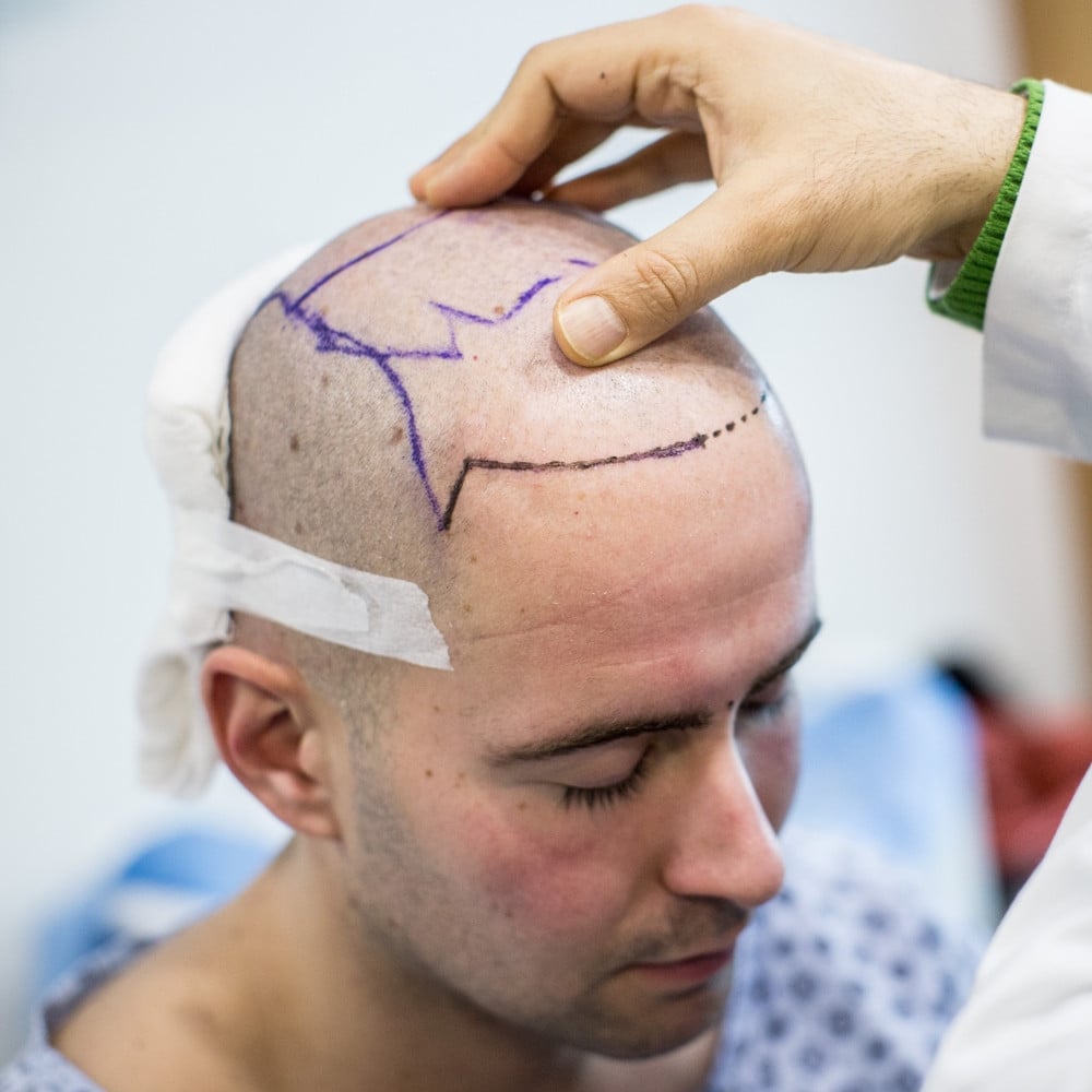 A Renowned Hair Transplant Surgeon Has Shared His Comments on the Matter